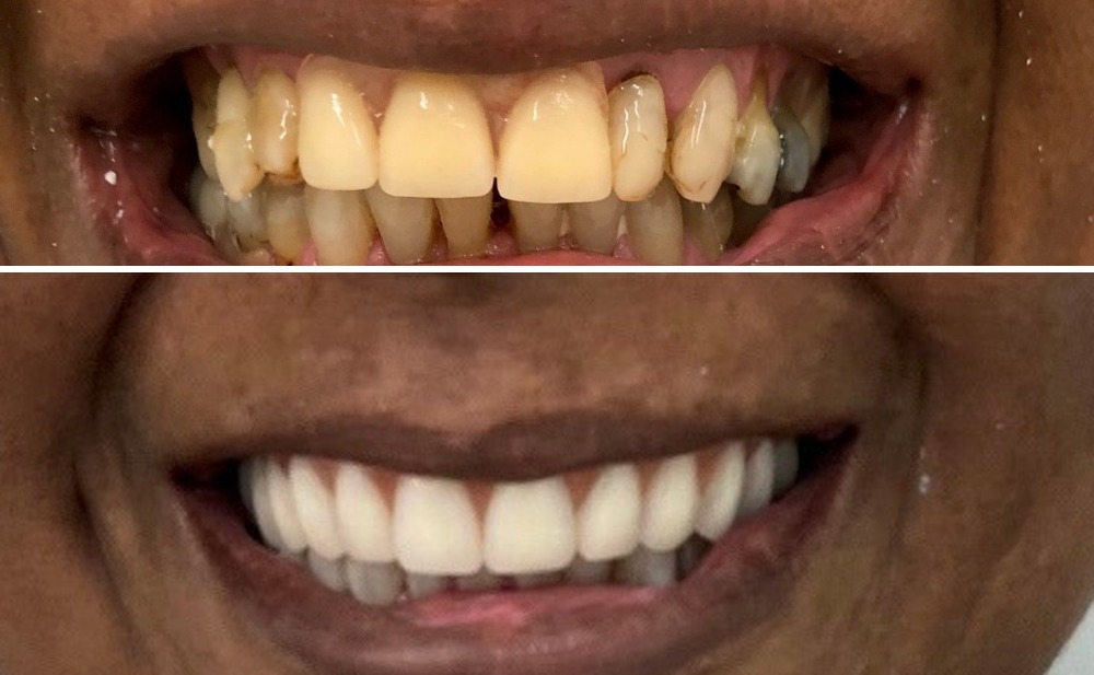 Antes e depois de reabilitação oral, enquadramento no sorriso